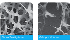 Osteoporosis vs Osteoarthritis