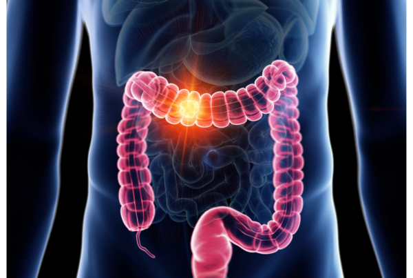 bowel cancer prevention exercise