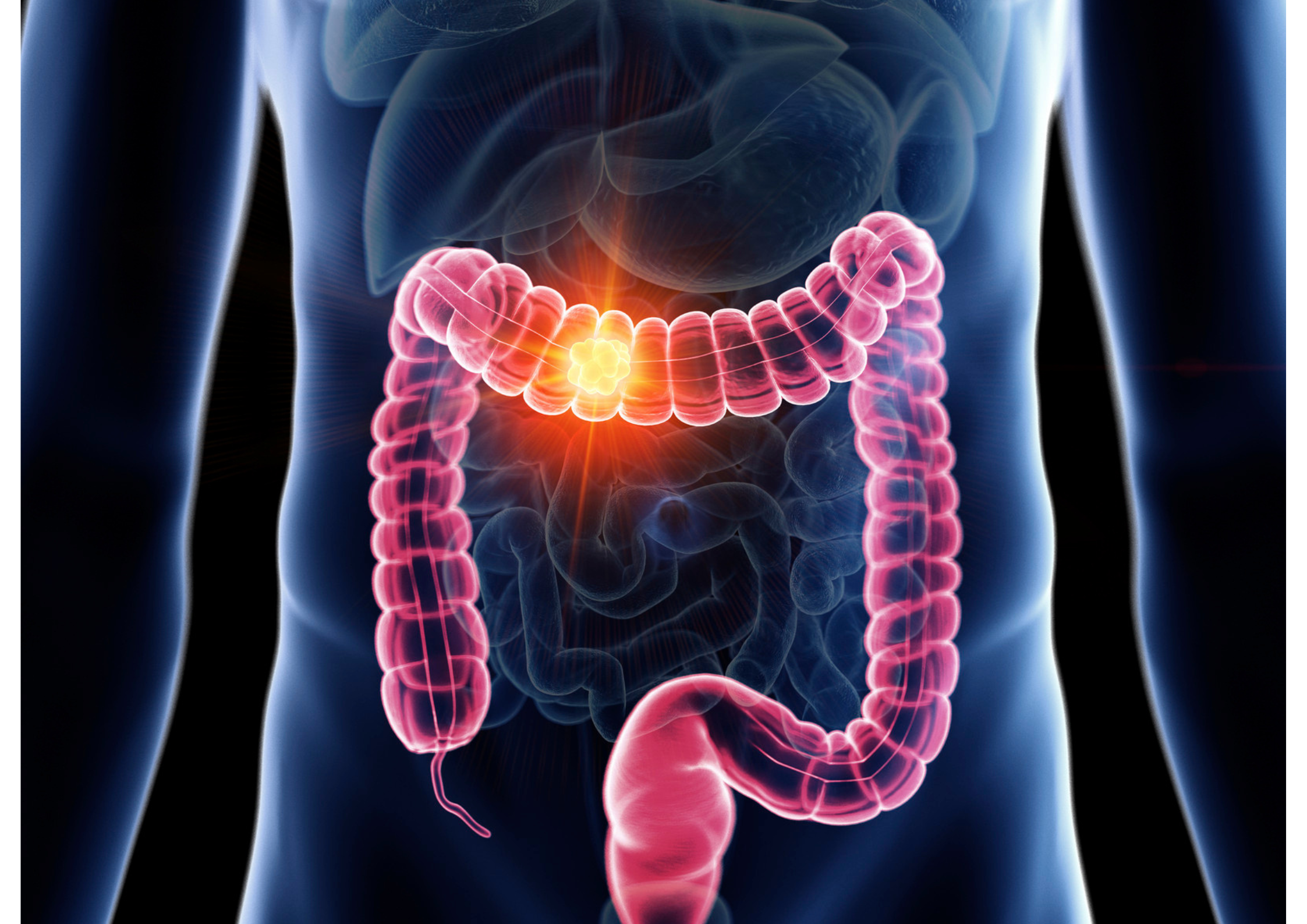 bowel cancer prevention exercise